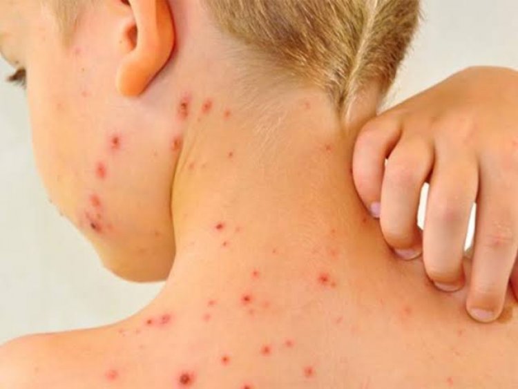 Hospital del Niño pide cuidados ante  los riesgos de sarampión en menores