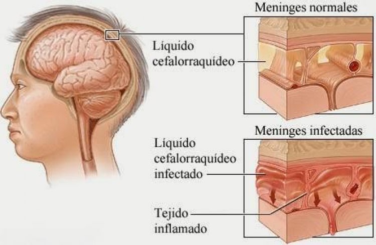 Debe evitarse la meningitis con  correctos hábitos en la higiene
