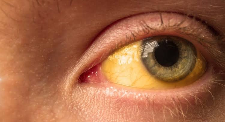 Insisten sobre la higiene para prevenir hepatitis A